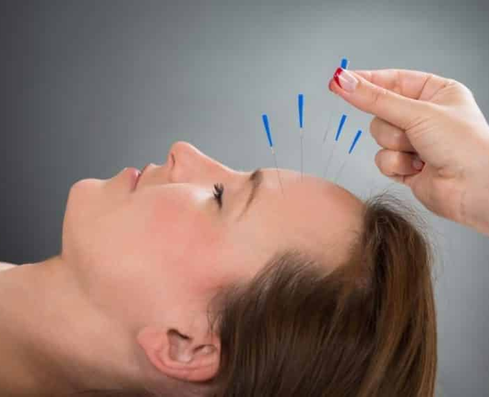 Acupuntura